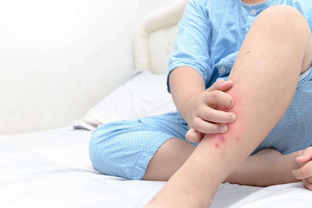 A child scratches the bed bug bites on their leg.