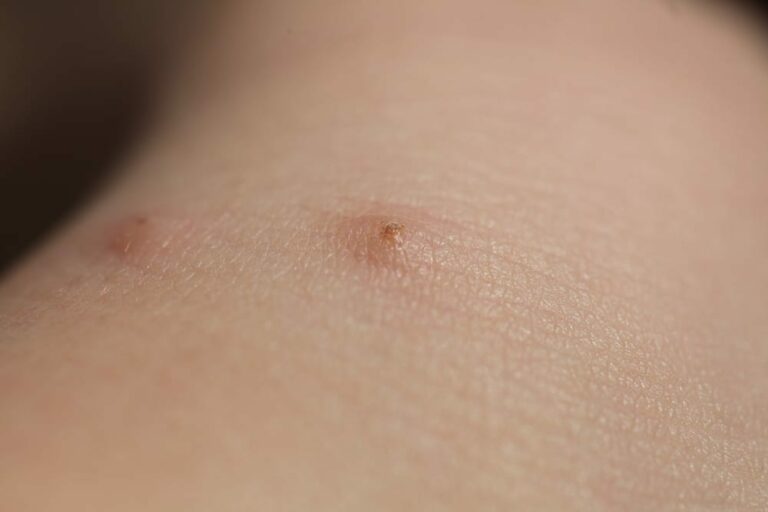 How To Quickly Identify A Bed Bug Bite