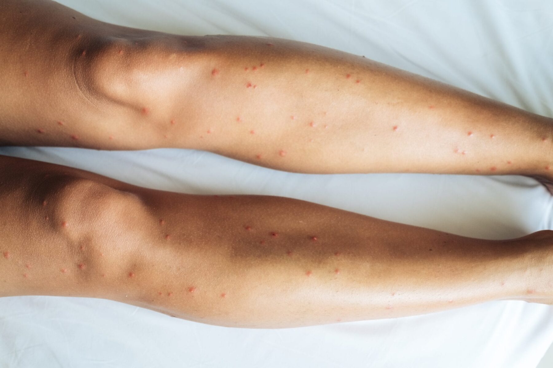 Female legs with many red spot and scar from sand fly bitesFemale legs with many red spot and scar from bed bug bites