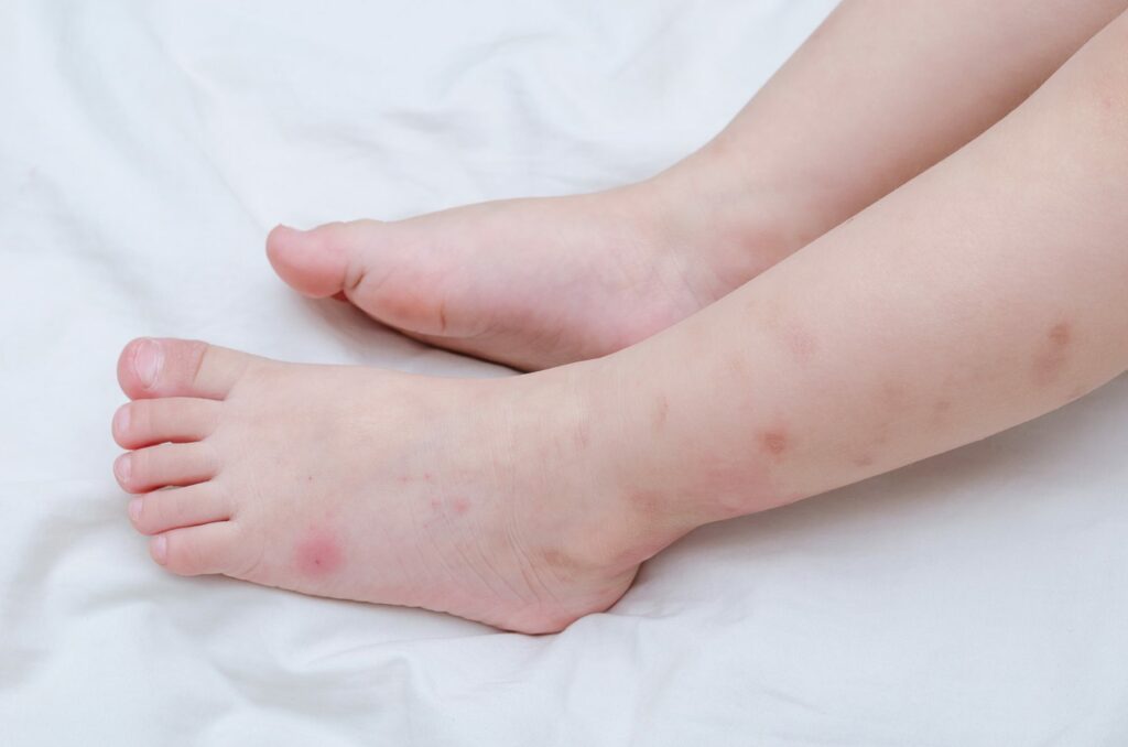 Bed bug bites sore on baby legs