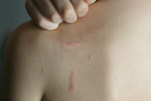 Person scratching bites on their back