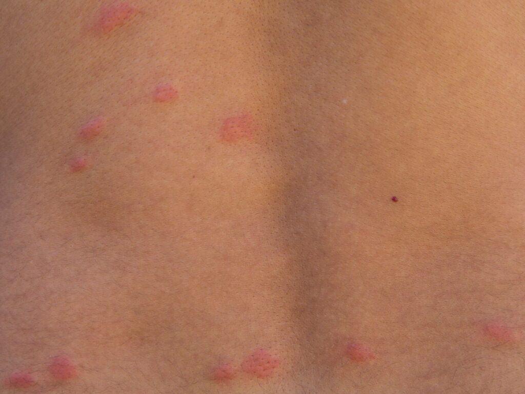 Bed bug bites on back of person