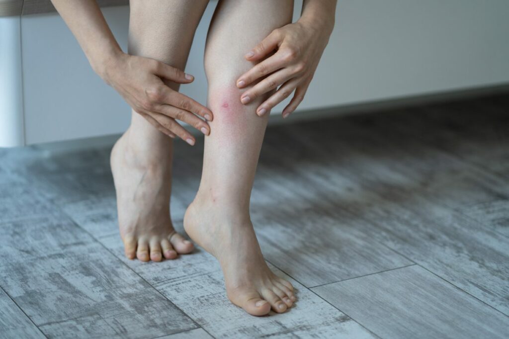 A person sitting on the side of their bed examines bug bite on their legs